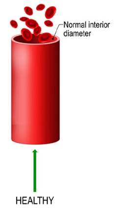 Hypertension or High Blood Pressure