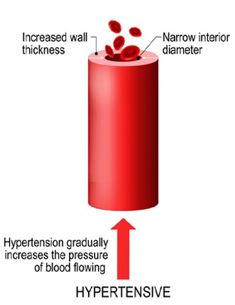 Hypertension or High Blood Pressure