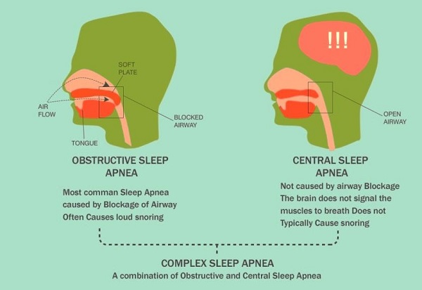 Sleep Apnea