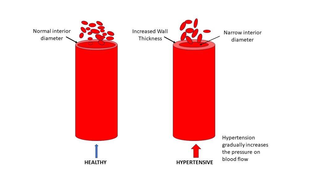 Cardiovascular Disease
