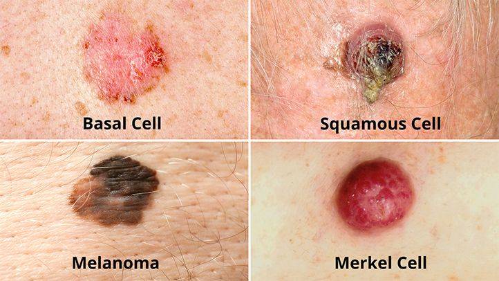 Skin Cancer Causes Symptoms and Treatments
