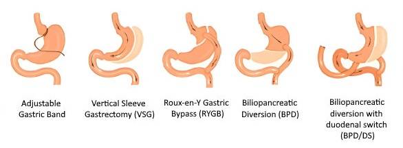 Bariatric Surgery