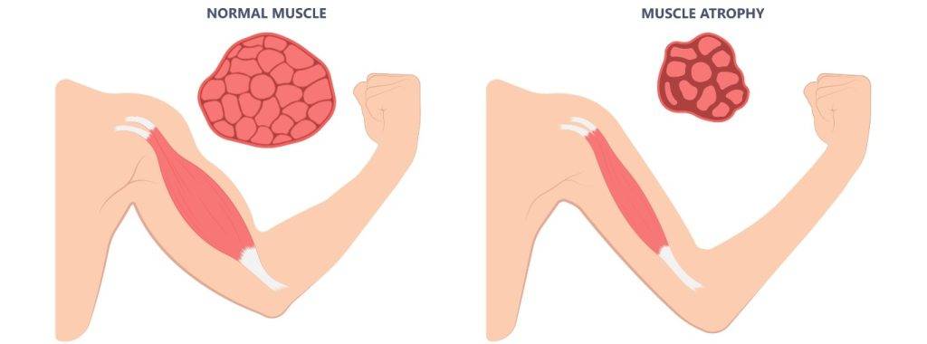 Muscle Atrophy