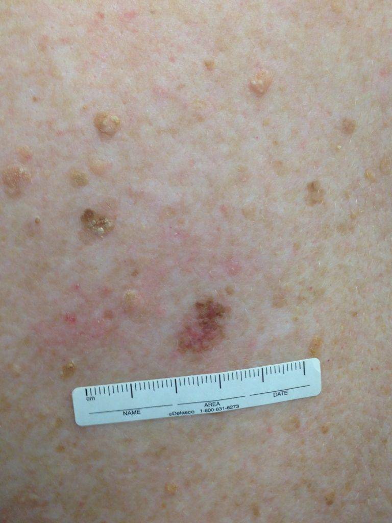 Is Skin Cancer in Australia on the Rise