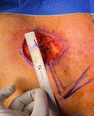 Melanoma
