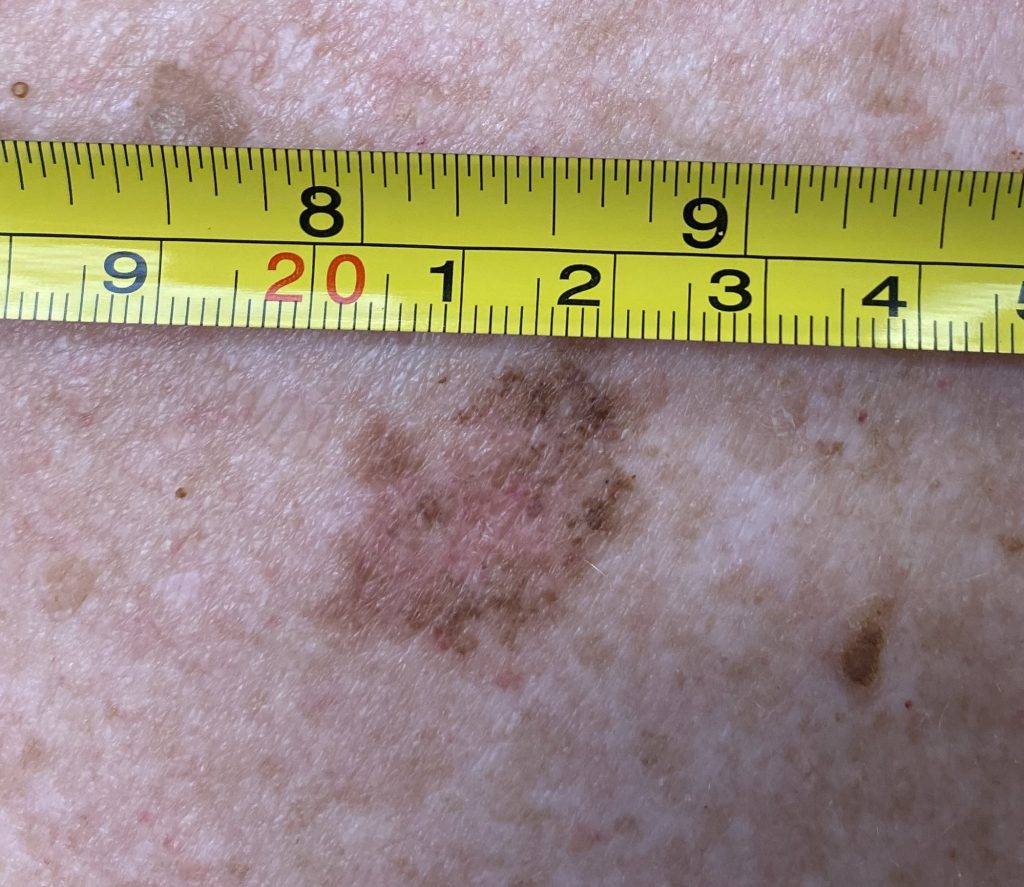 Skin Cancer
