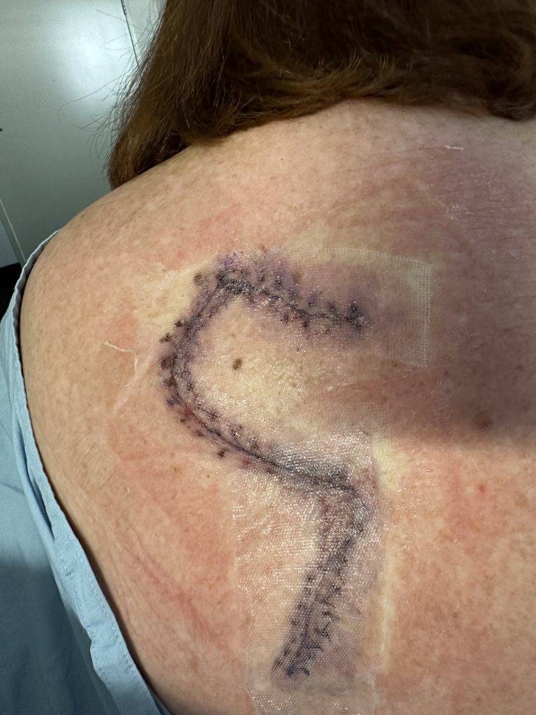 Skin Cancer Flap